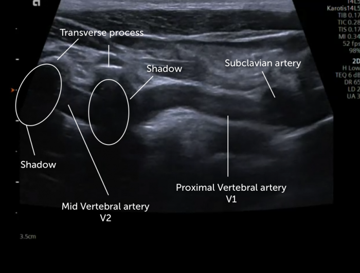 Vertebral Artery