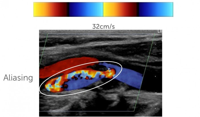 3. Instrumentation and physical principles of carotid (Duplex ...