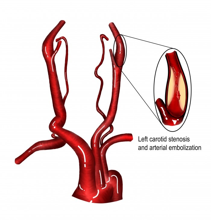 Stenosis Illustration Stenosis Illustration