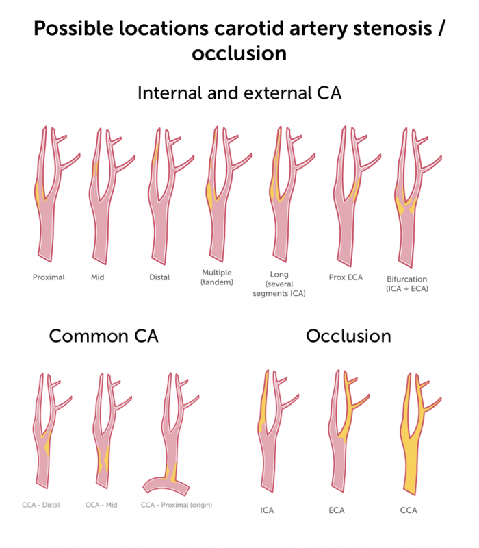 11. Carotid Artery Stenosis Part 1: B mode and Color flow | 123 Sonography