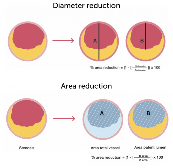 Area Diameter reduction