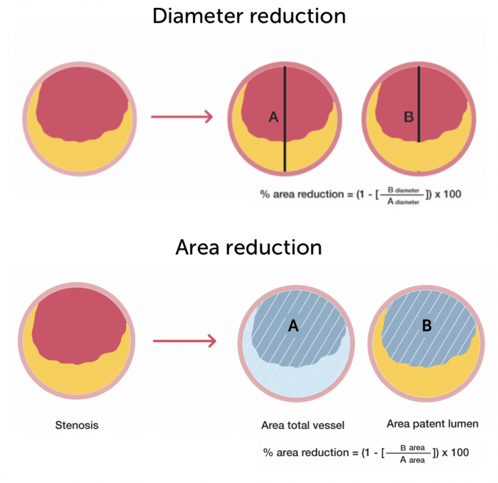 Area Diameter reduction Area Diameter reduction