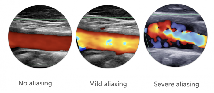 Aliasing grade Aliasing grade