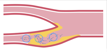 Direction of flow in stenosis