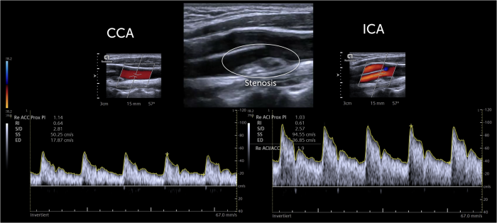 Mild Carotid stenosis