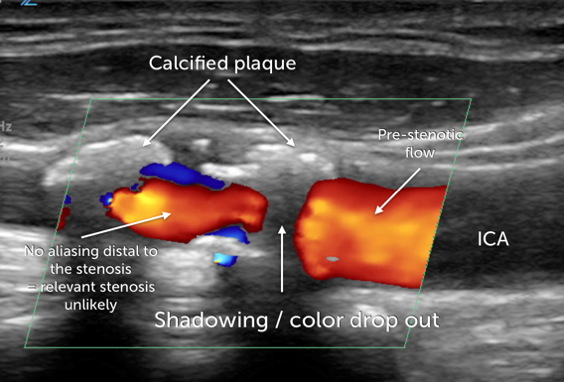 calcified lesion illustr.