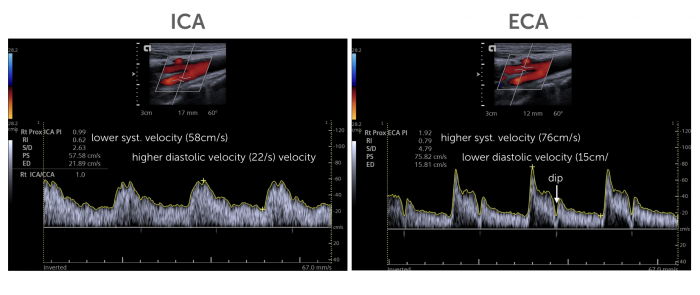 8. ECA vs ICA - External versus internal carotid artery | 123 Sonography