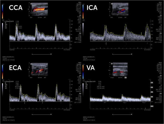 8. ECA vs ICA - External versus internal carotid artery | 123 Sonography