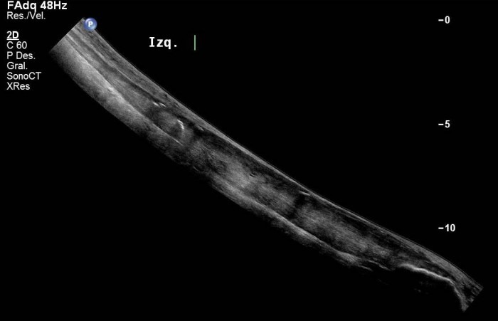 Achilles tendon left, longitudinal view