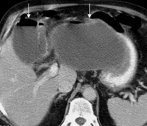 CT scan at the level of image 4