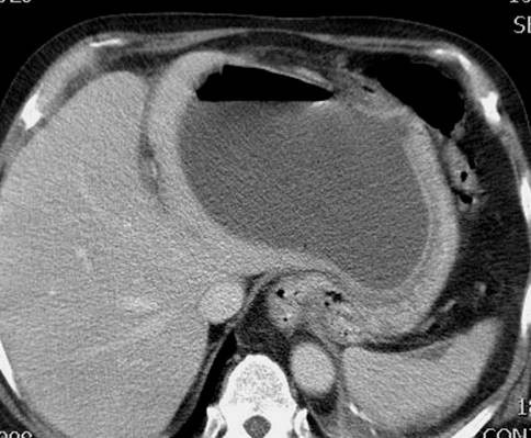 CT scan at the level of image 5