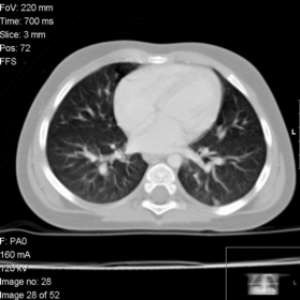 CT scan of the chest