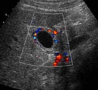 Color Doppler view of the gallbladder