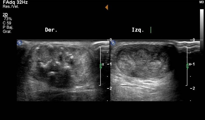 Comparative right (Der.) and left (Izq.) transversal Achilles