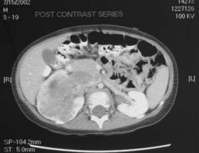 Contrast enhanced axial CT scan (picture 2)