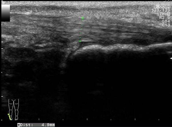 Longitudinal image of the contralateral (left) distal Achilles tendon