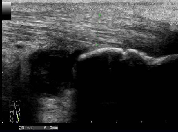 Longitudinal image of the right distal Achilles tendon (picture 2)