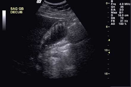 Sagittal gallbladder