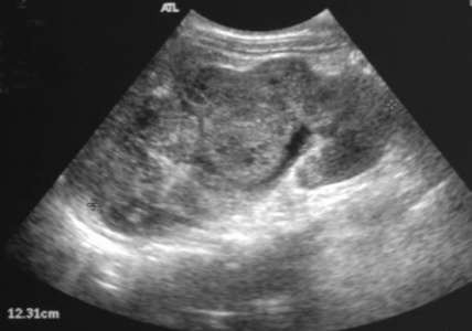 Sagittal image of the right kidney (picture 2)