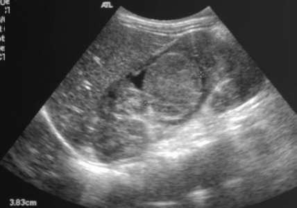 Sagittal image of the right kidney