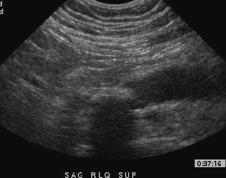 Sagittal sonogram of the right lower quadrant