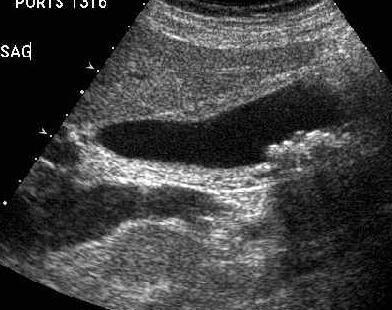 Sagittal view of the gallbladder
