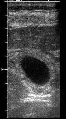 Transverse-scan-of-the-gallbladder