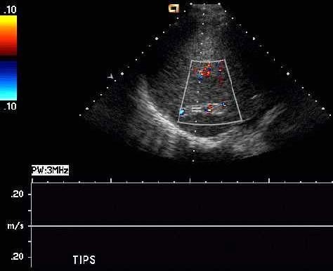 Spectral Doppler of the TIPS stent