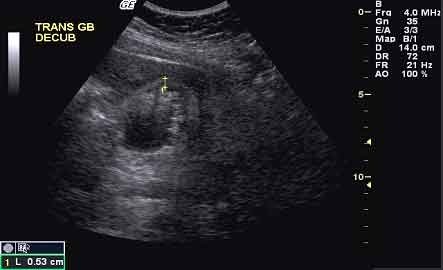 Transverse gallbladder Transverse gallbladder