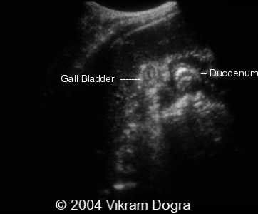 Transverse oblique image of right upper quadrant