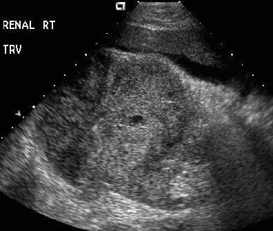 Transverse view of the right kidney