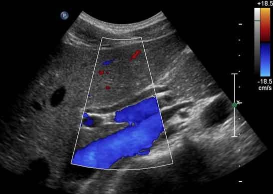 View of Common Bile Duct