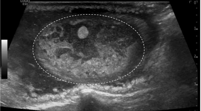 Abdominal ultrasound of an infant showing extraluminal abscess and meconium collection.