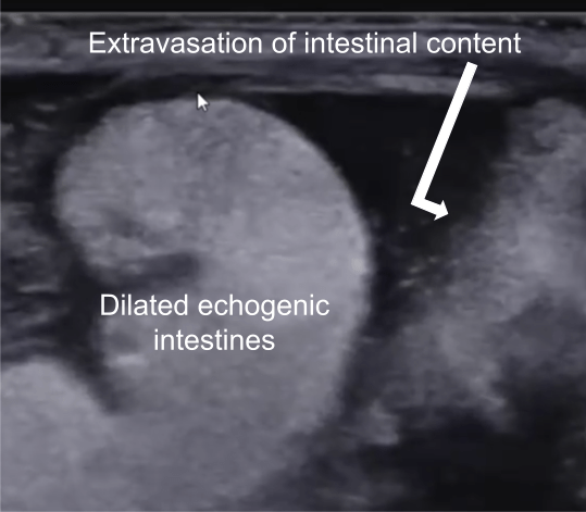 Abdominal ultrasound of an infant showing intestinal content spillage.