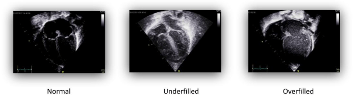 Ultrasound image of A4C in normal, underfilled, and overfilled state.