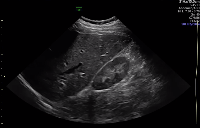 Ultrasound 101 - Part 4: Depth and focus