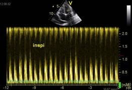 Mitral inflow velocity recorded with pulsed-wave Doppler