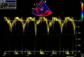 Tissue Doppler velocity tracing at the mitral annulus