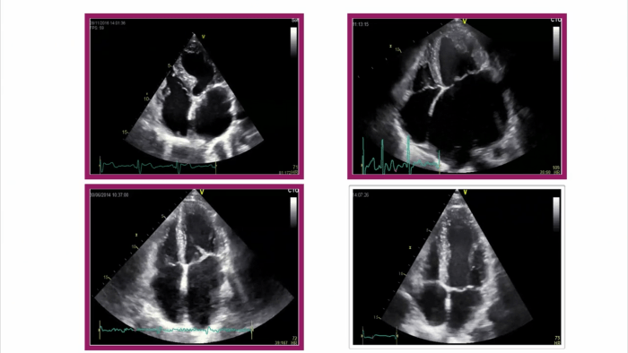 Ultrasound image of left atrium.