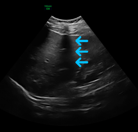 Ultrasound image of liver.
