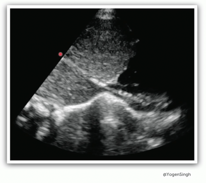 Ultrasound image of neonatal abdomen.