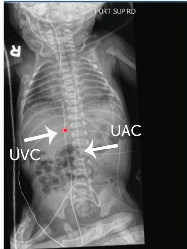 X-ray image of neonate's abdomen with tags UVC and UAC.