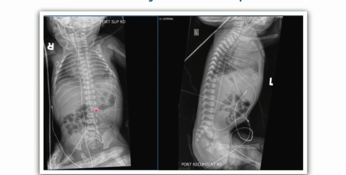 X-ray image of neonate's abdomen.