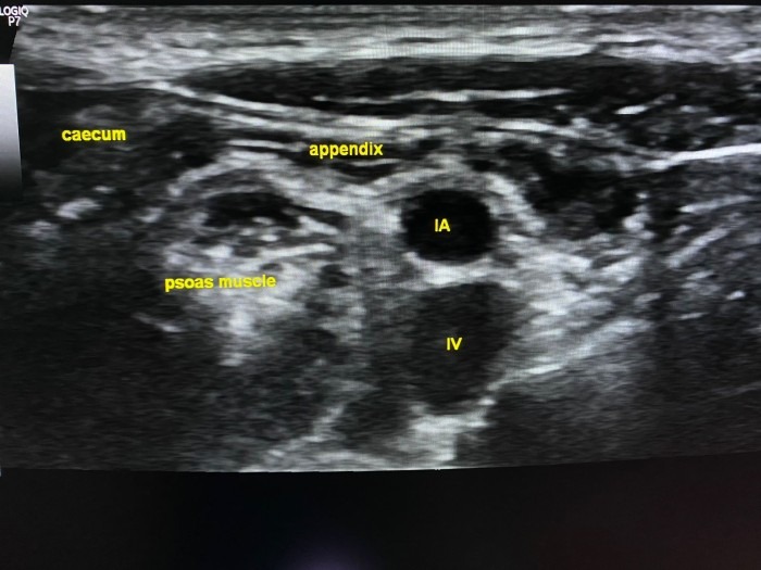 Ultrasound image of normal sonoanatomy of the appendix.