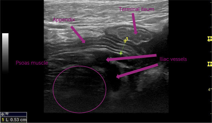 Ultrasound image of the normal sonoanatomy of the appendix.