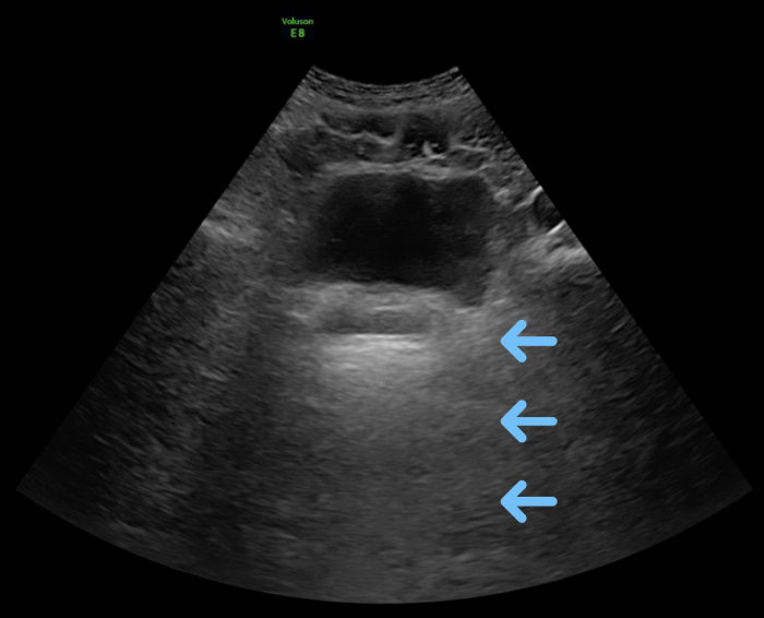 Urinary bladder ultrasound image.