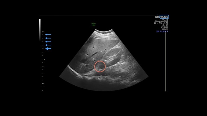 Ultrasound image of liver and right kidney with marker on cranial pole of kidney.