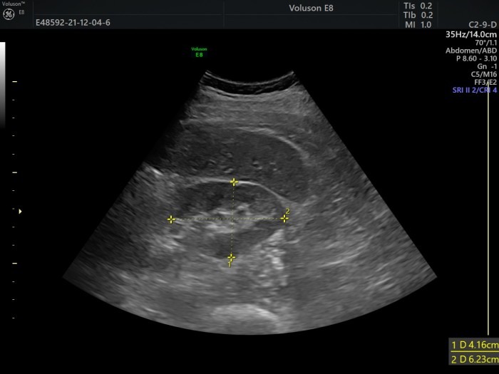 Ultrasound image of liver and right kidney with measurements.