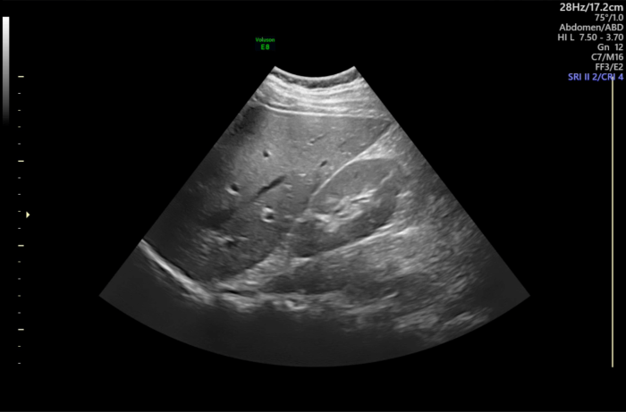 Ultrasound image of liver and right kidney.