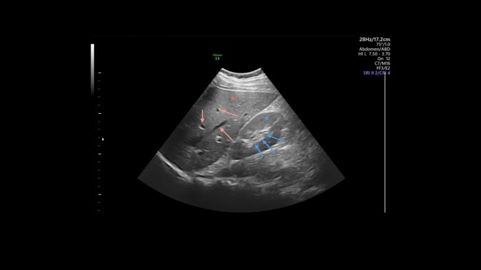 Ultrasound image of liver and right kidney with marker on renal pelvis.